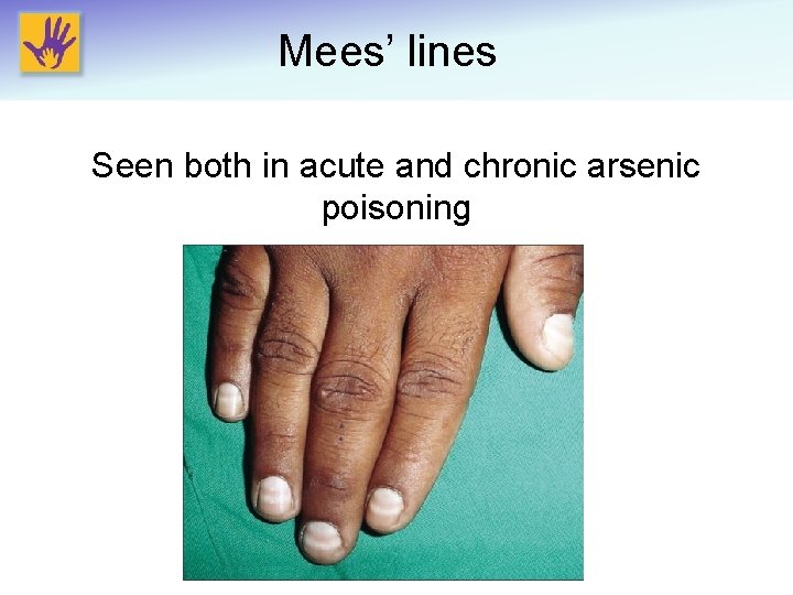 Mees’ lines Seen both in acute and chronic arsenic poisoning 