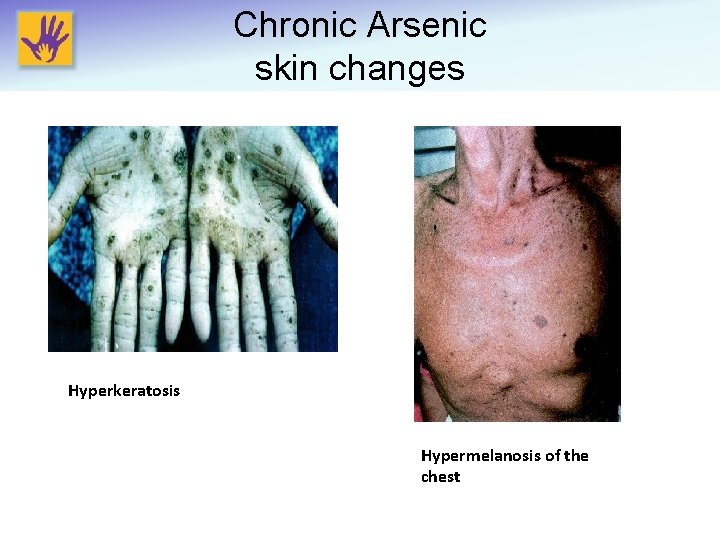 Chronic Arsenic skin changes Hyperkeratosis Hypermelanosis of the chest 