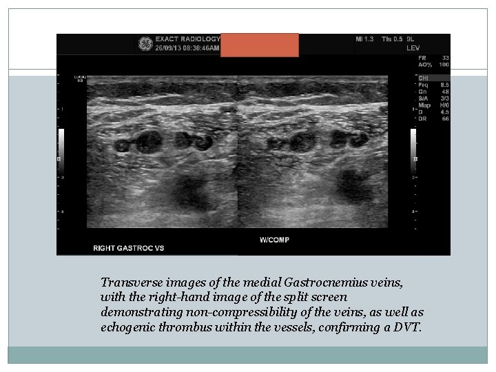 Transverse images of the medial Gastrocnemius veins, with the right-hand image of the split Transverse images of the medial Gastrocnemius veins, with the right-hand image of the split