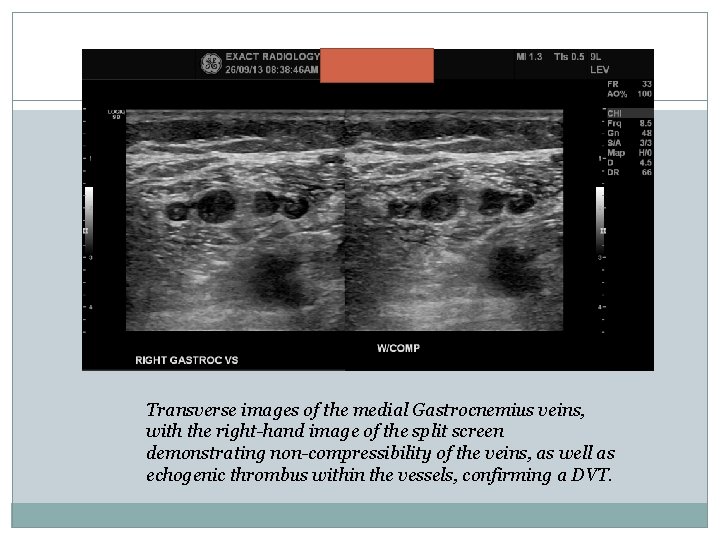 Transverse images of the medial Gastrocnemius veins, with the right-hand image of the split