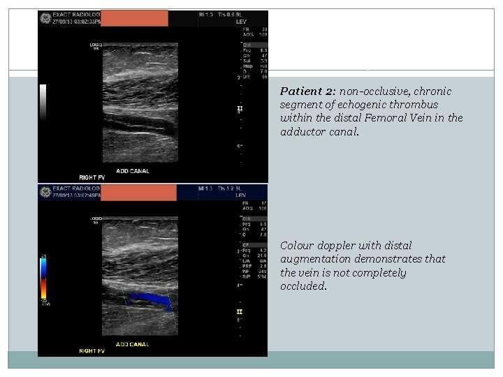 Patient 2: non-occlusive, chronic segment of echogenic thrombus within the distal Femoral Vein in Patient 2: non-occlusive, chronic segment of echogenic thrombus within the distal Femoral Vein in