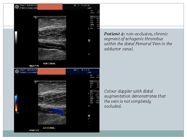 Patient 2: non-occlusive, chronic segment of echogenic thrombus within the distal Femoral Vein in