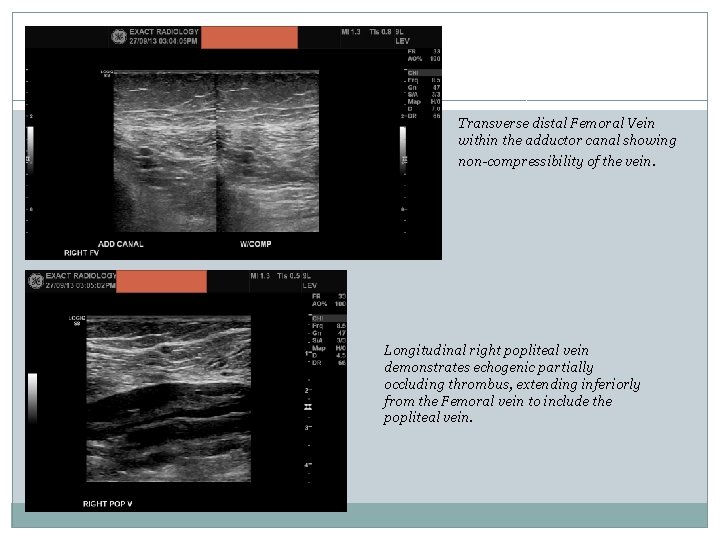 Transverse distal Femoral Vein within the adductor canal showing non-compressibility of the vein. Longitudinal Transverse distal Femoral Vein within the adductor canal showing non-compressibility of the vein. Longitudinal