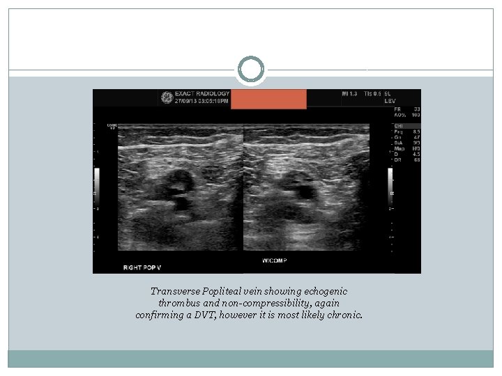 Transverse Popliteal vein showing echogenic thrombus and non-compressibility, again confirming a DVT, however it