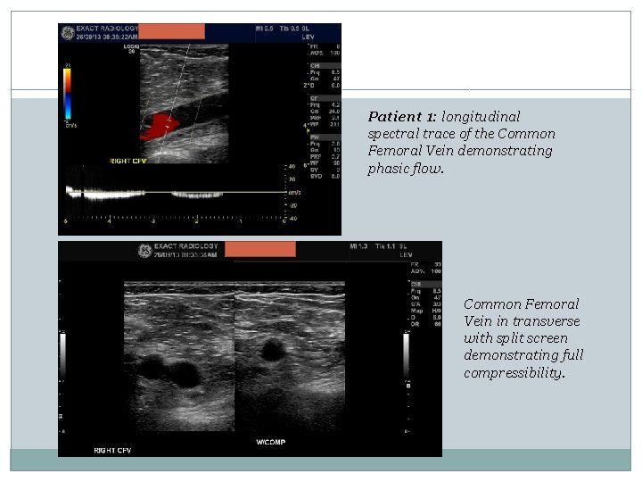Patient 1: longitudinal spectral trace of the Common Femoral Vein demonstrating phasic flow. Common Patient 1: longitudinal spectral trace of the Common Femoral Vein demonstrating phasic flow. Common