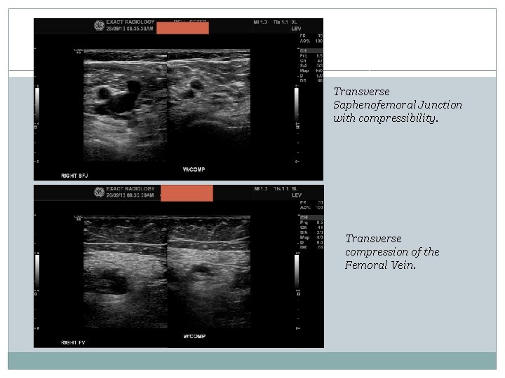 Transverse Saphenofemoral Junction with compressibility. Transverse compression of the Femoral Vein. Transverse Saphenofemoral Junction with compressibility. Transverse compression of the Femoral Vein.