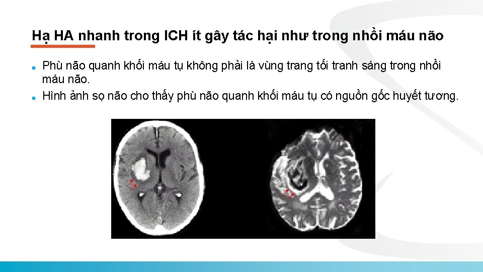 Hạ HA nhanh trong ICH ít gây tác hại như trong nhồi máu não