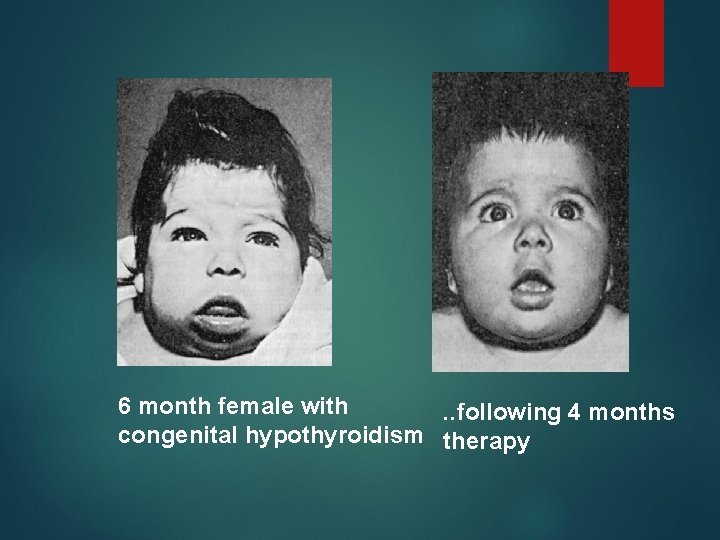 6 month female with. . following 4 months congenital hypothyroidism therapy 