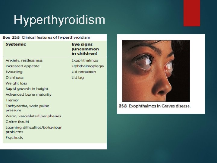 Hyperthyroidism 