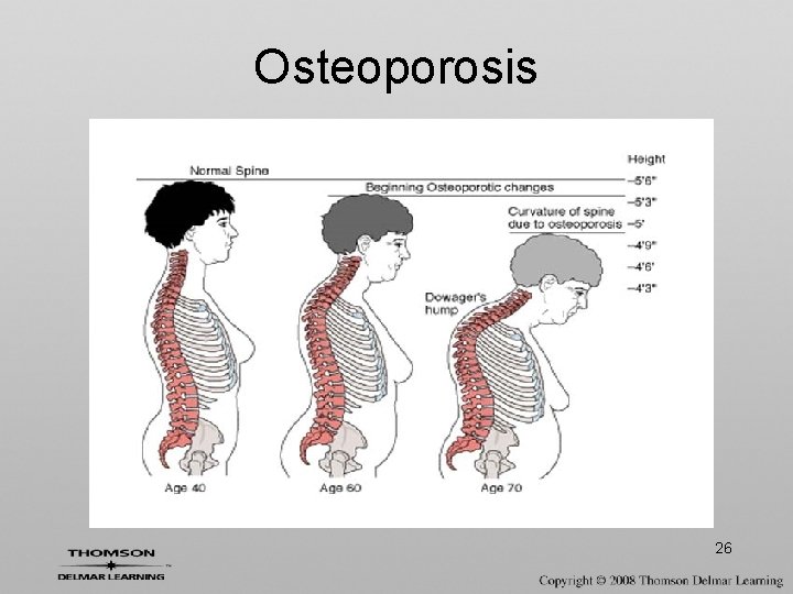 Osteoporosis 26 