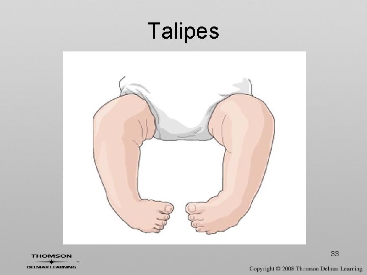 Talipes 33 