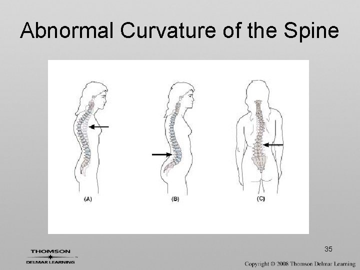 Abnormal Curvature of the Spine 35 