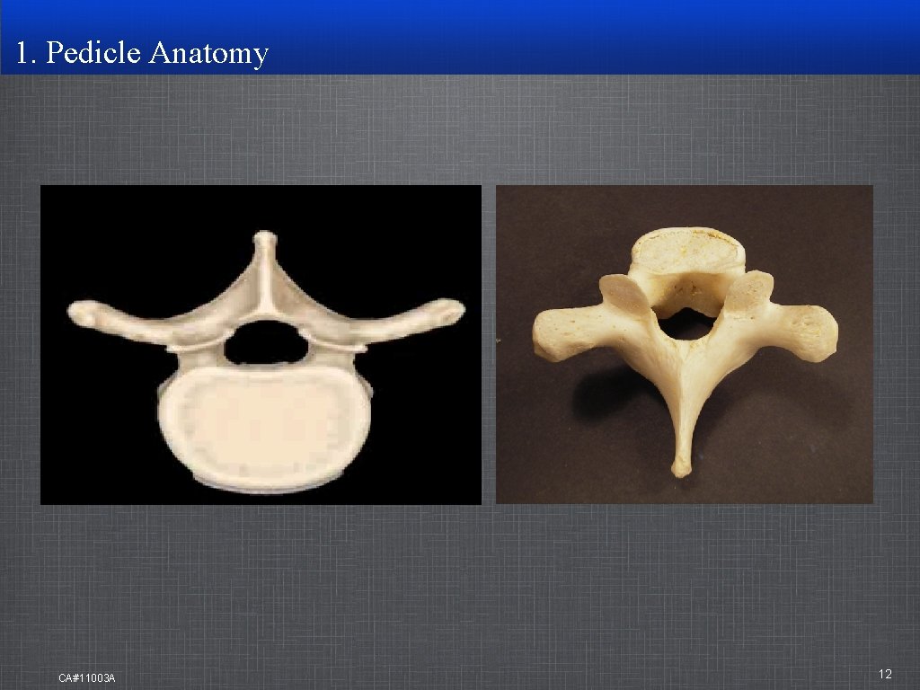 1. Pedicle Anatomy CA#11003 A 12 