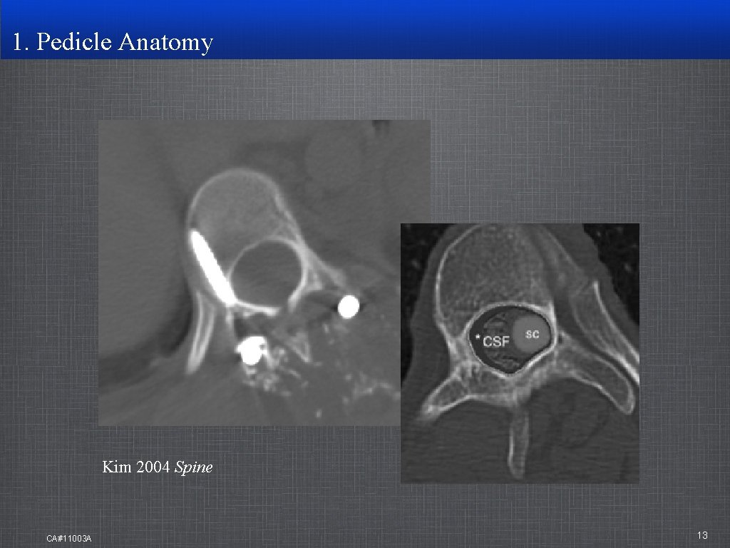 1. Pedicle Anatomy Kim 2004 Spine CA#11003 A 13 