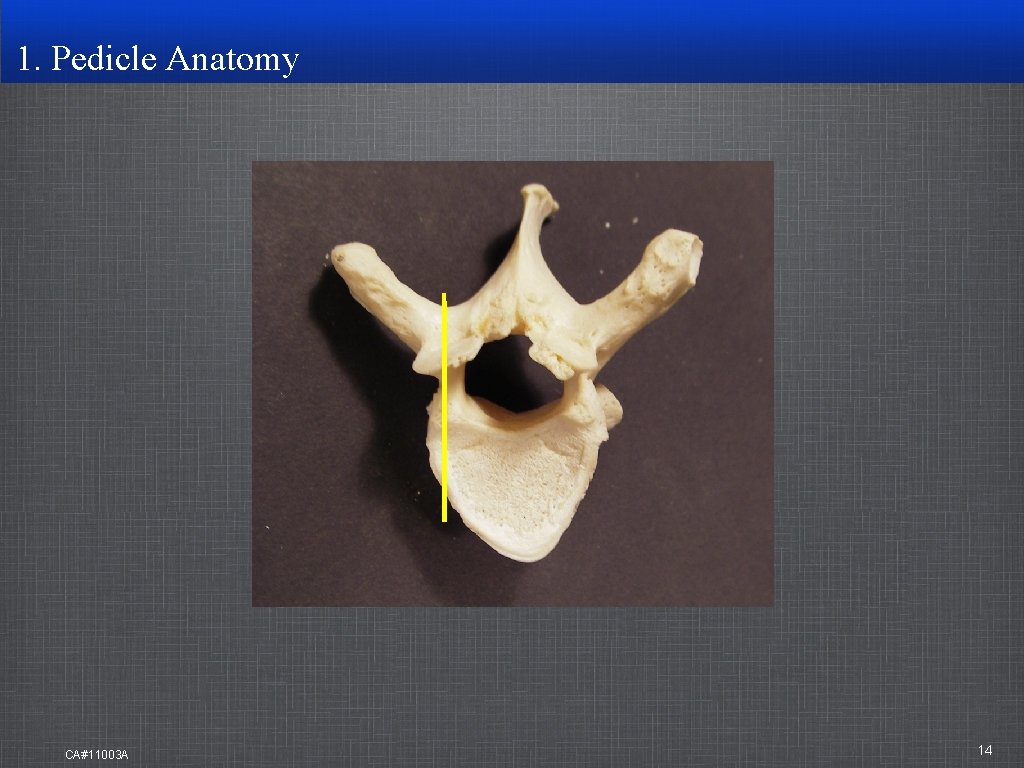 1. Pedicle Anatomy CA#11003 A 14 