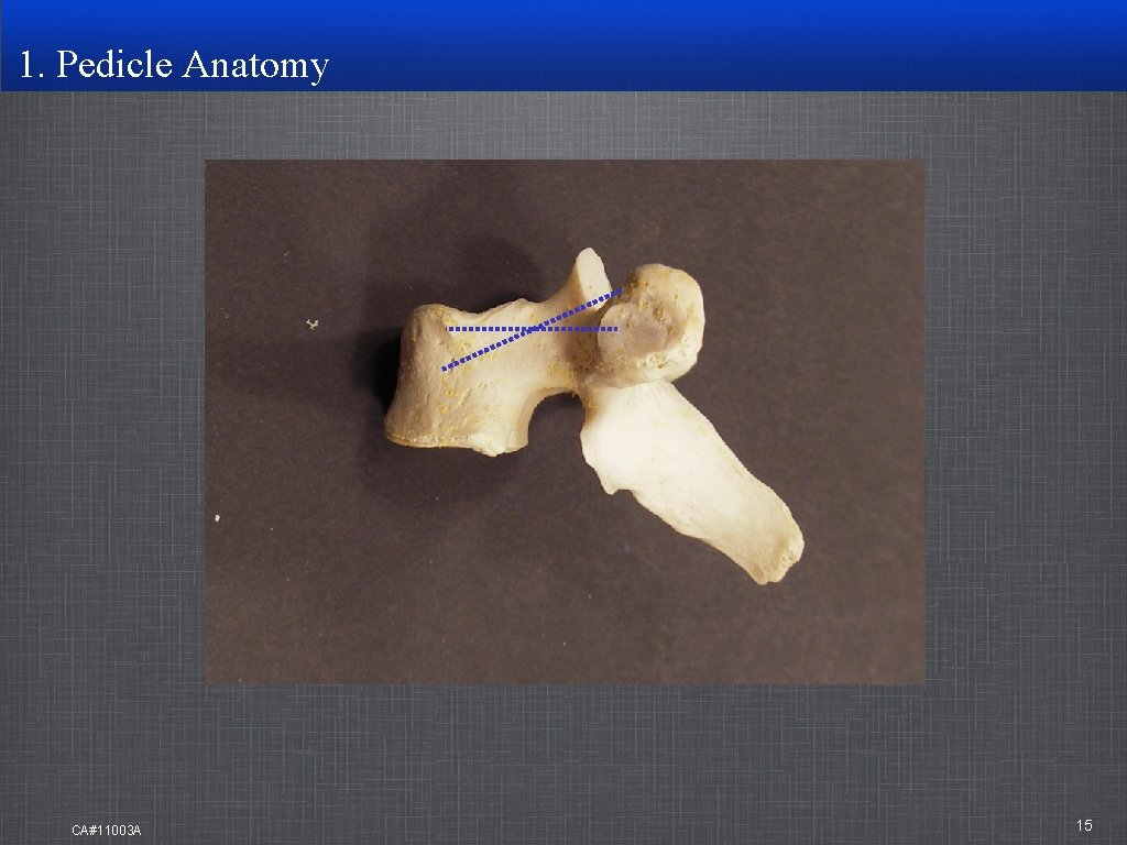 1. Pedicle Anatomy CA#11003 A 15 