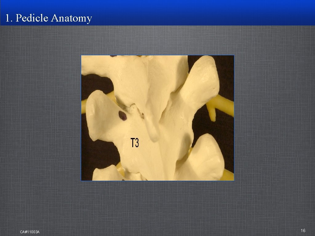1. Pedicle Anatomy CA#11003 A 16 