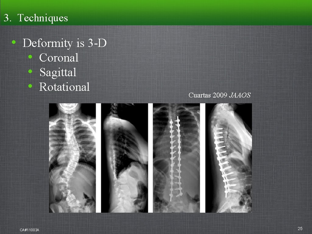 3. Techniques • Deformity is 3 -D • Coronal • Sagittal • Rotational CA#11003