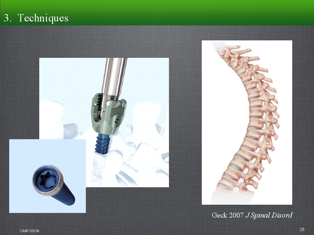 3. Techniques Geck 2007 J Spinal Disord CA#11003 A 28 