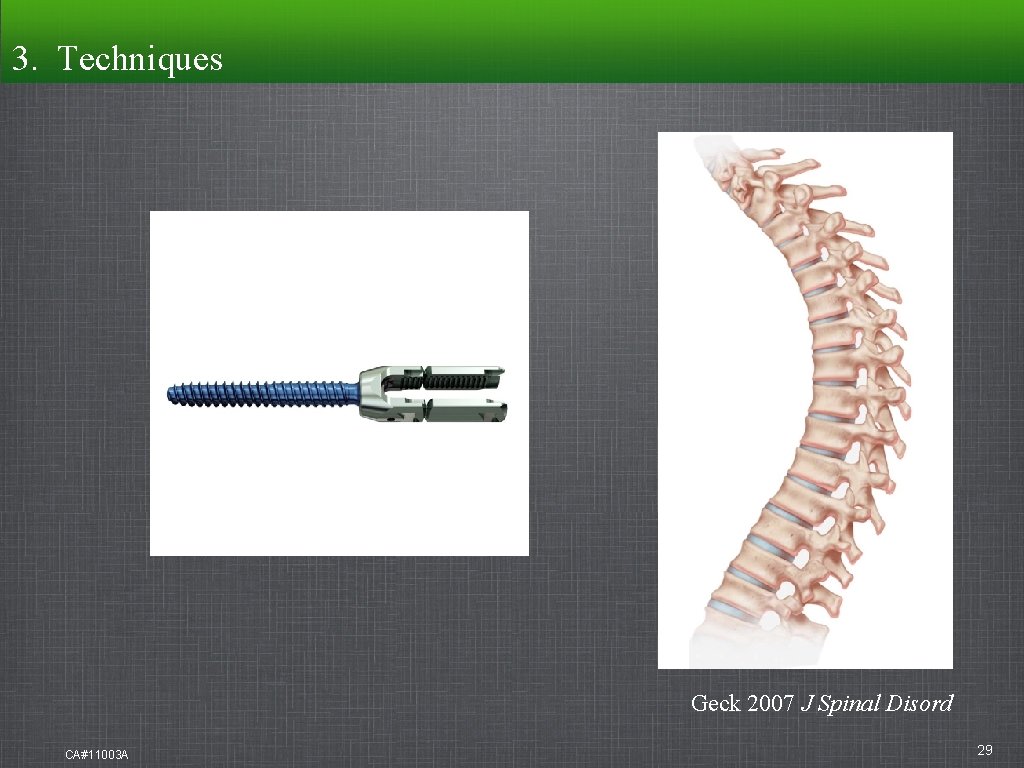 3. Techniques Geck 2007 J Spinal Disord CA#11003 A 29 