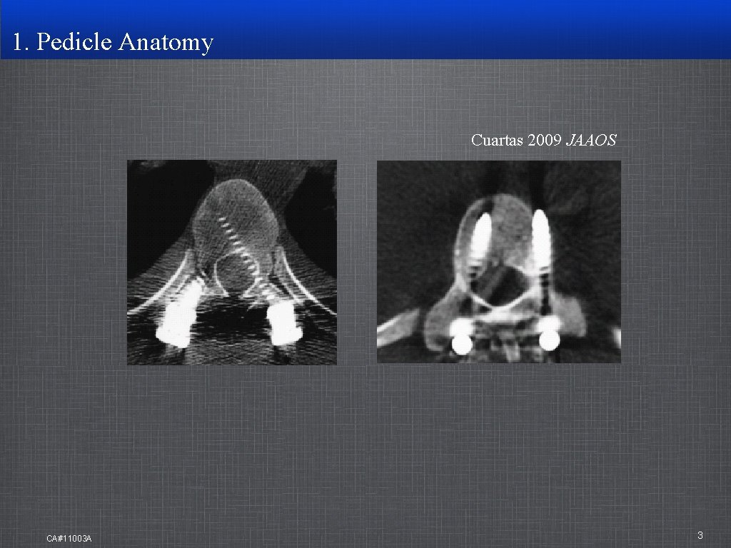 1. Pedicle Anatomy Cuartas 2009 JAAOS CA#11003 A 3 