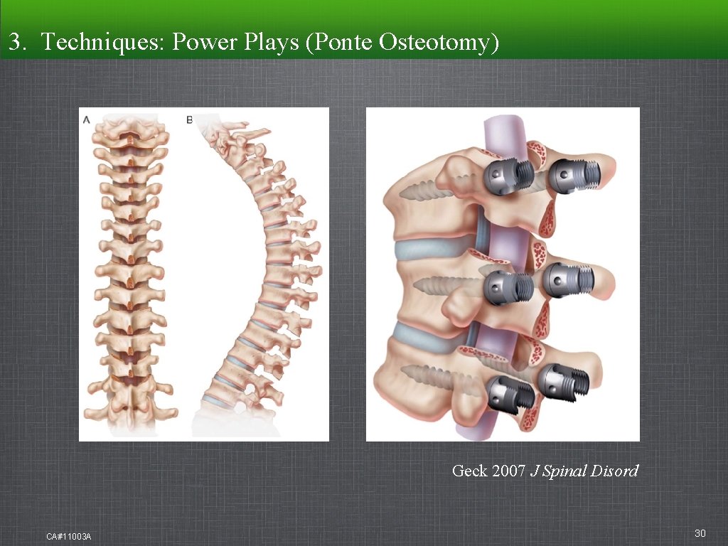 3. Techniques: Power Plays (Ponte Osteotomy) Geck 2007 J Spinal Disord CA#11003 A 30