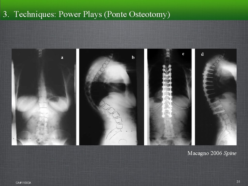 3. Techniques: Power Plays (Ponte Osteotomy) Macagno 2006 Spine CA#11003 A 31 