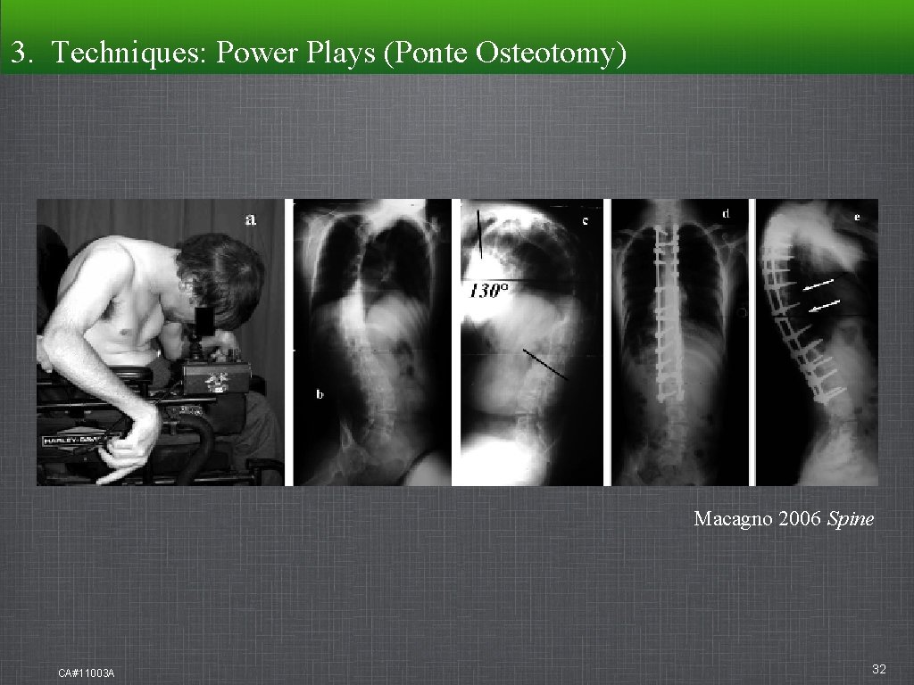 3. Techniques: Techniques Power Plays (Ponte Osteotomy) Macagno 2006 Spine CA#11003 A 32 