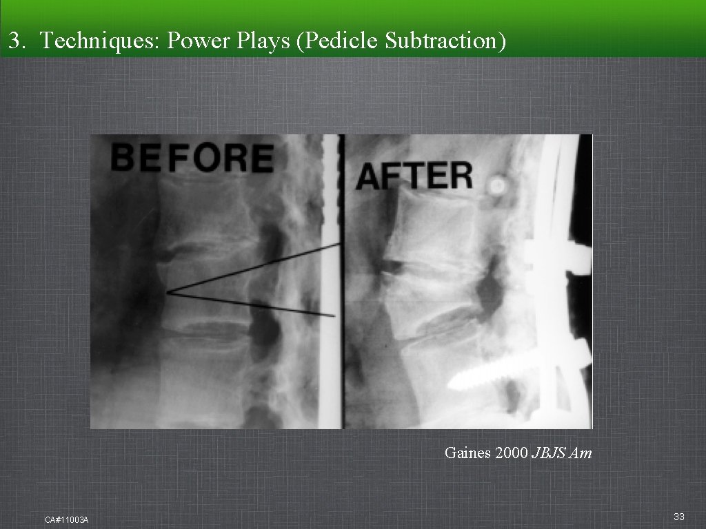 3. Techniques: Techniques Power Plays (Pedicle Subtraction) Gaines 2000 JBJS Am CA#11003 A 33