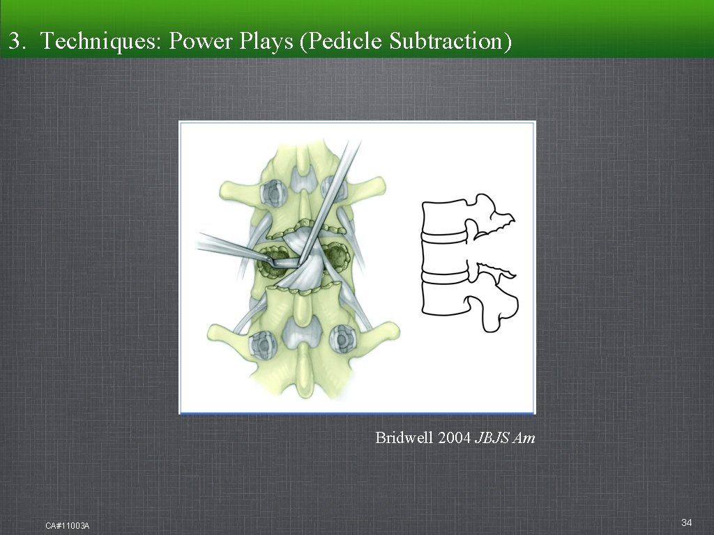 3. Techniques: Techniques Power Plays (Pedicle Subtraction) Bridwell 2004 JBJS Am CA#11003 A 34