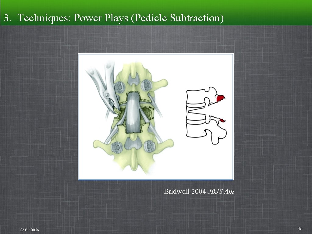 3. Techniques: Techniques Power Plays (Pedicle Subtraction) Bridwell 2004 JBJS Am CA#11003 A 35