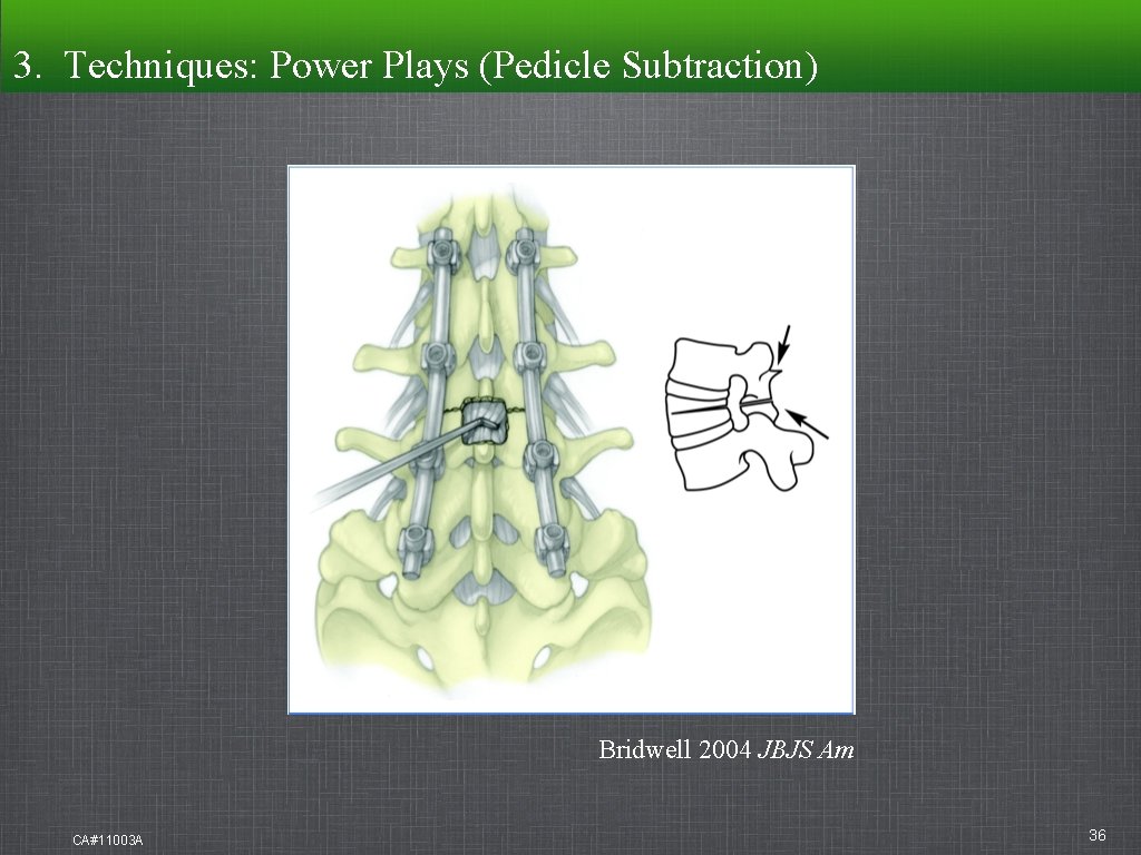 3. Techniques: Techniques Power Plays (Pedicle Subtraction) Bridwell 2004 JBJS Am CA#11003 A 36