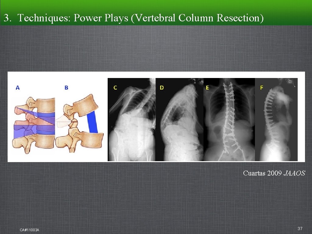 3. Techniques: Power Plays (Vertebral Column Resection) Cuartas 2009 JAAOS CA#11003 A 37 