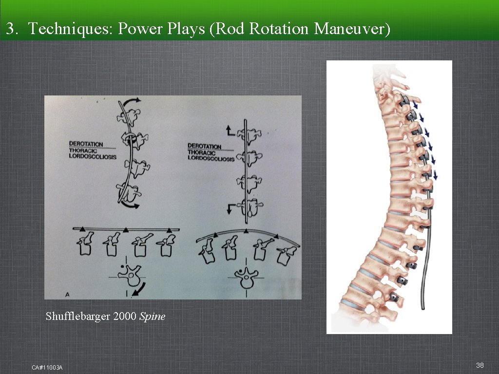 3. Techniques: Power Plays (Rod Rotation Maneuver) Shufflebarger 2000 Spine CA#11003 A 38 