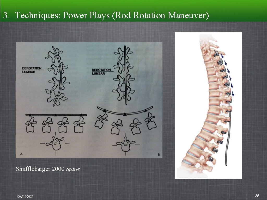 3. Techniques: Power Plays (Rod Rotation Maneuver) Shufflebarger 2000 Spine CA#11003 A 39 