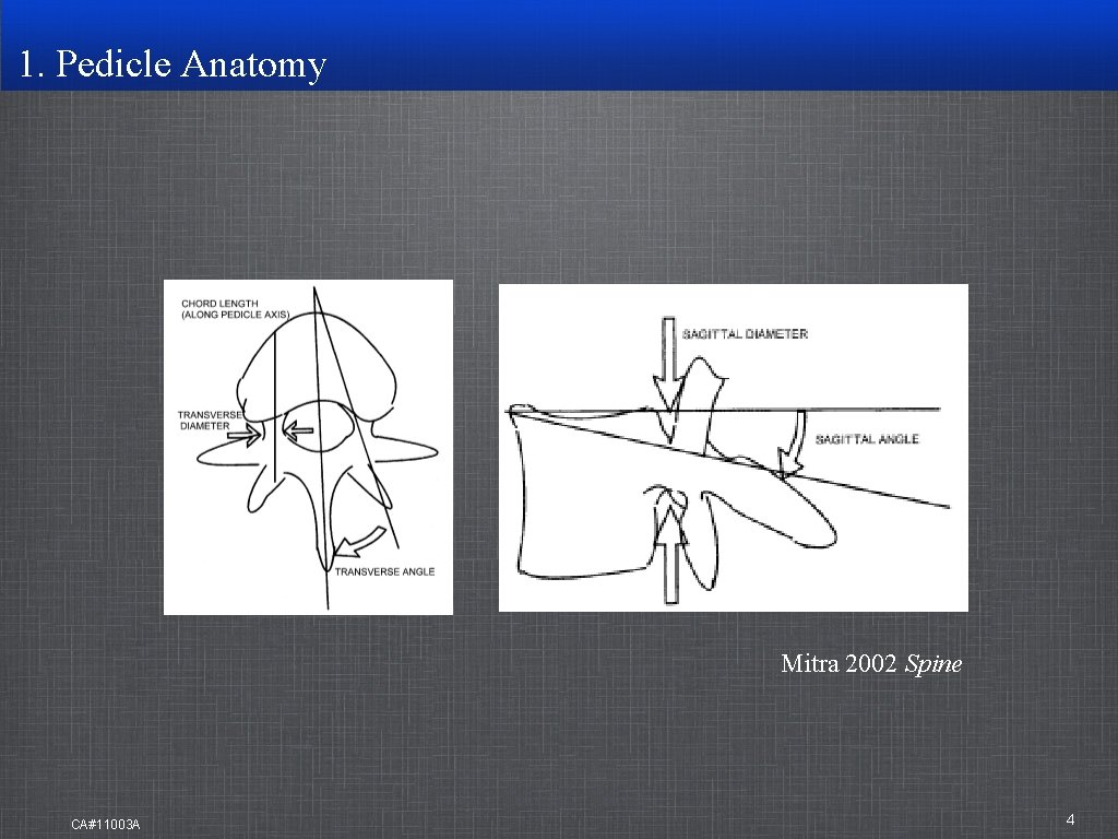 1. Pedicle Anatomy Mitra 2002 Spine CA#11003 A 4 