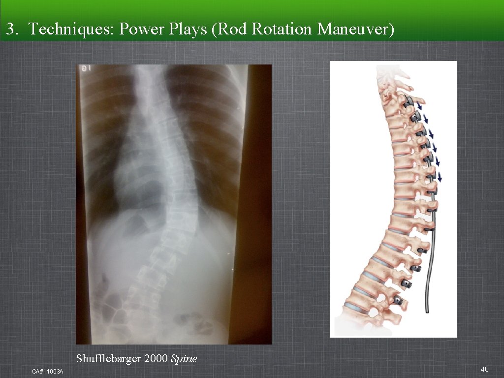 3. Techniques: Power Plays (Rod Rotation Maneuver) Shufflebarger 2000 Spine CA#11003 A 40 