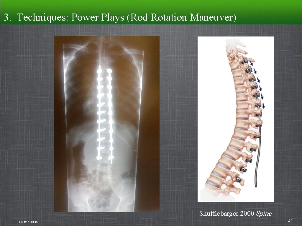 3. Techniques: Power Plays (Rod Rotation Maneuver) Shufflebarger 2000 Spine CA#11003 A 41 