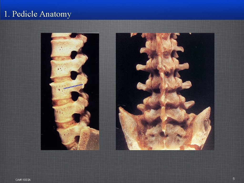 1. Pedicle Anatomy CA#11003 A 5 