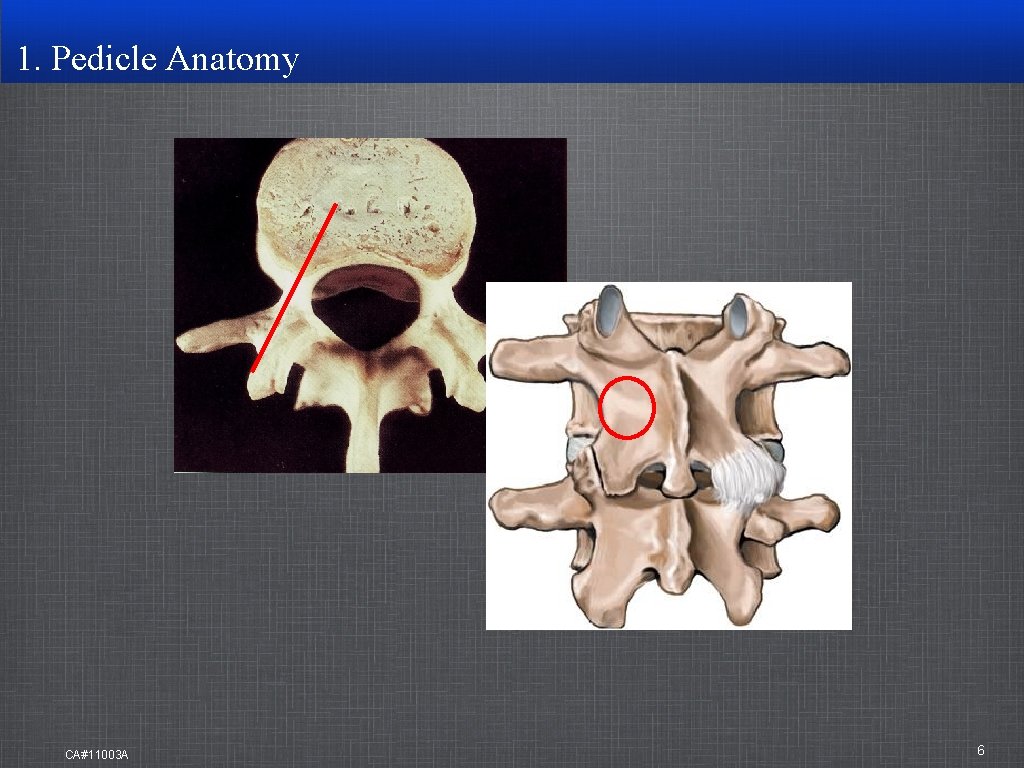 1. Pedicle Anatomy CA#11003 A 6 