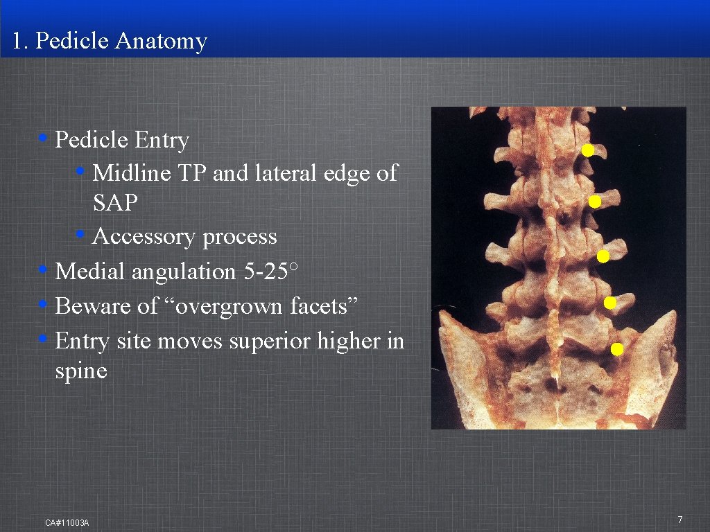 1. Pedicle Anatomy • Pedicle Entry • Midline TP and lateral edge of SAP