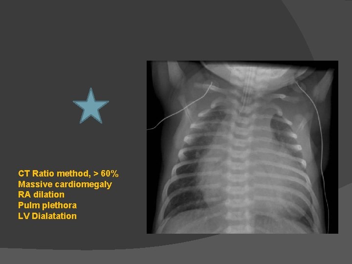 CT Ratio method, > 60% Massive cardiomegaly RA dilation Pulm plethora LV Dialatation 