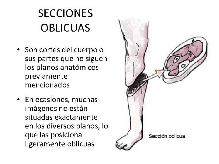 SECCIONES OBLICUAS • Son cortes del cuerpo o sus partes que no siguen los