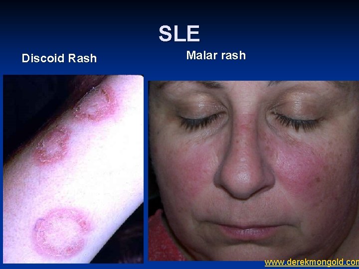 SLE Discoid Rash Malar rash www. derekmongold. com 