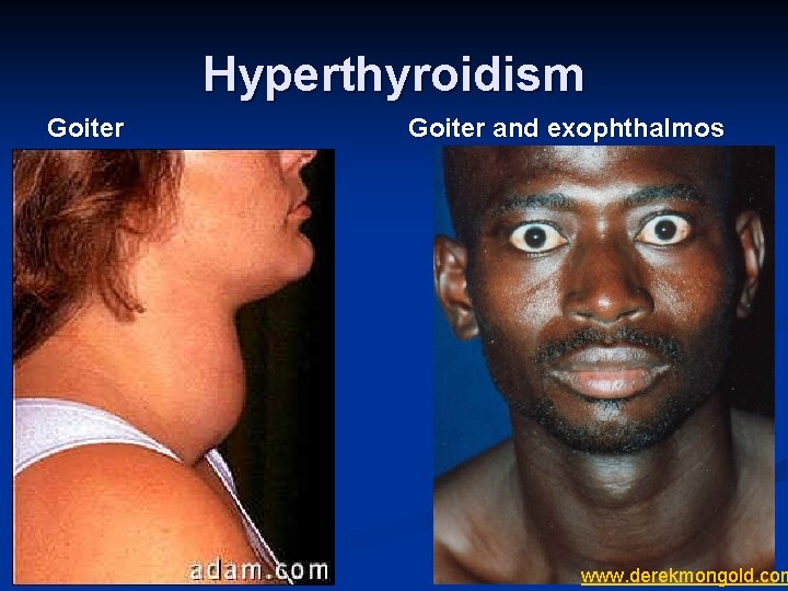 Hyperthyroidism Goiter and exophthalmos www. derekmongold. com 