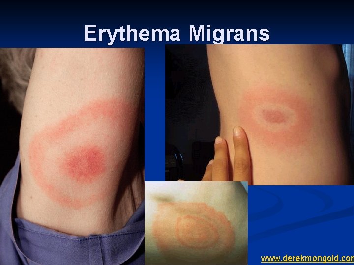 Erythema Migrans www. derekmongold. com 