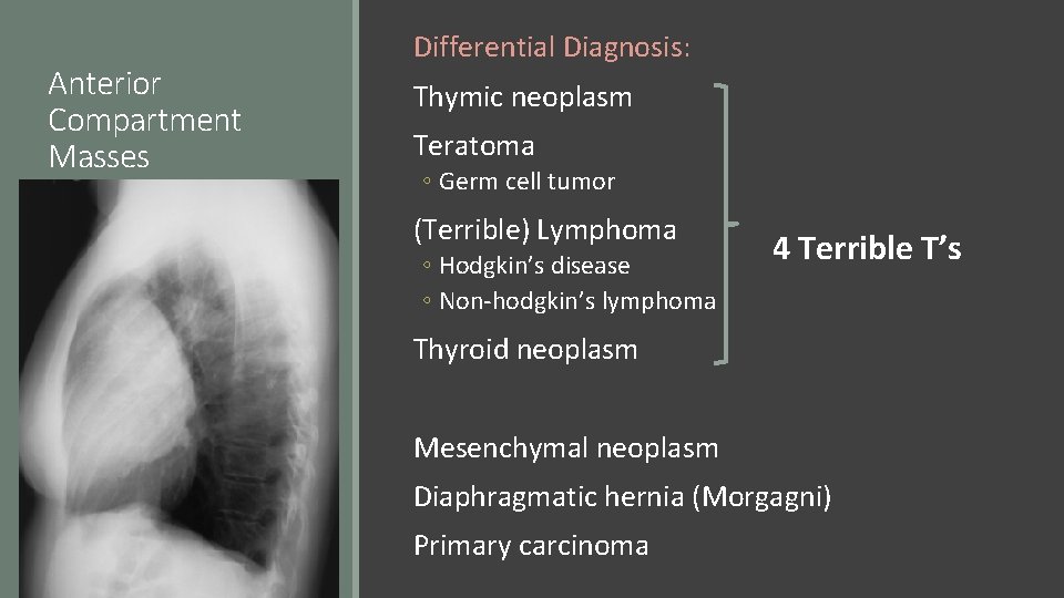 Anterior Compartment Masses Differential Diagnosis: Thymic neoplasm Teratoma ◦ Germ cell tumor (Terrible) Lymphoma