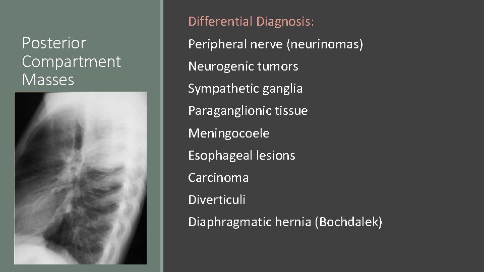 Differential Diagnosis: Posterior Compartment Masses Peripheral nerve (neurinomas) Neurogenic tumors Sympathetic ganglia Paraganglionic tissue