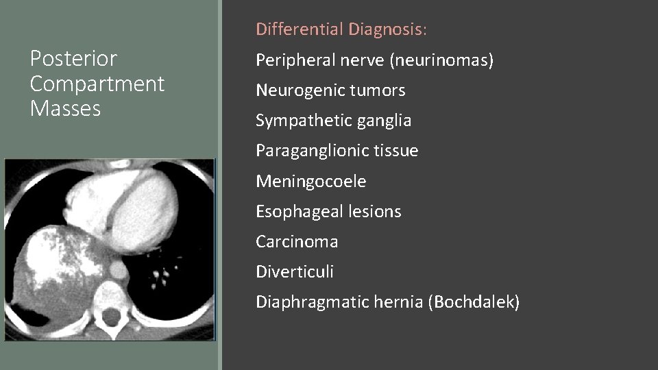 Differential Diagnosis: Posterior Compartment Masses Peripheral nerve (neurinomas) Neurogenic tumors Sympathetic ganglia Paraganglionic tissue