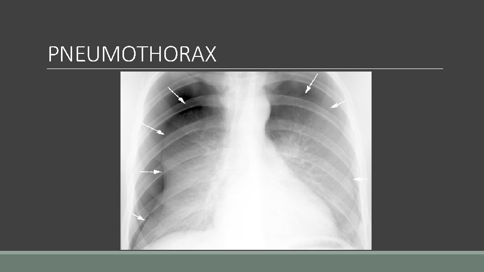 PNEUMOTHORAX 